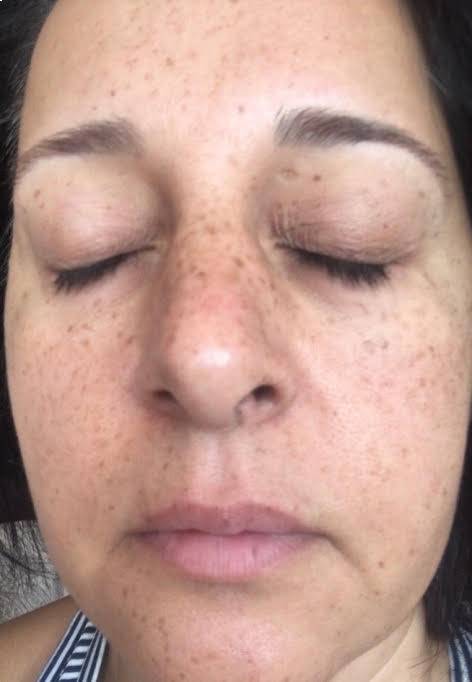 Laser Resurfacing Before and After Photos