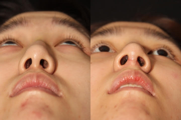 Before and After Asian Rhinoplasty 3