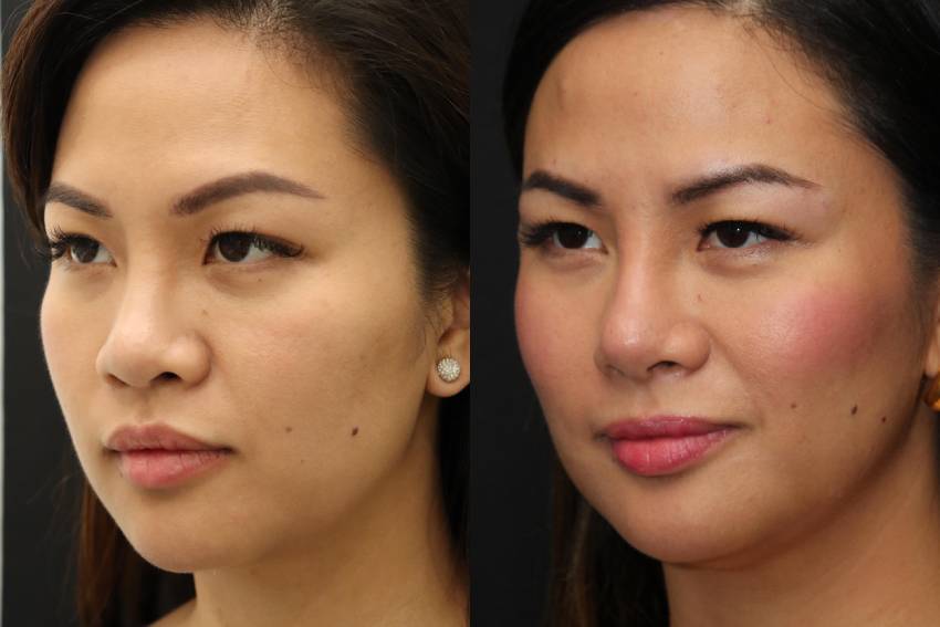Before and After Asian Rhinoplasty 2