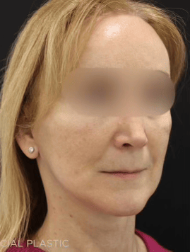 Before and After Deep Plane Facelift Surgery