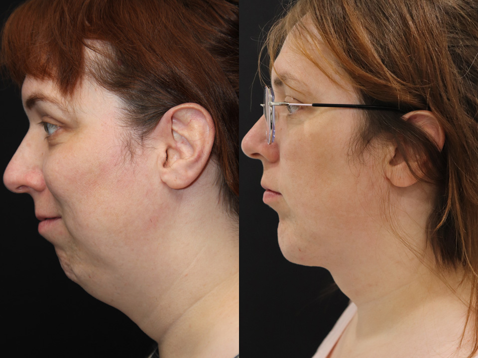 Male Face Lift And Neck Lift Before And After Toronto