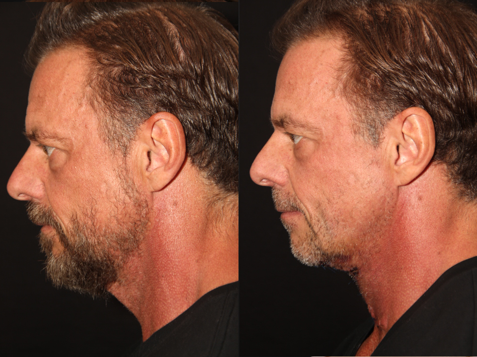 FACE LIFT AND NECK LIFT BEFORE AND AFTER TORONTO 3