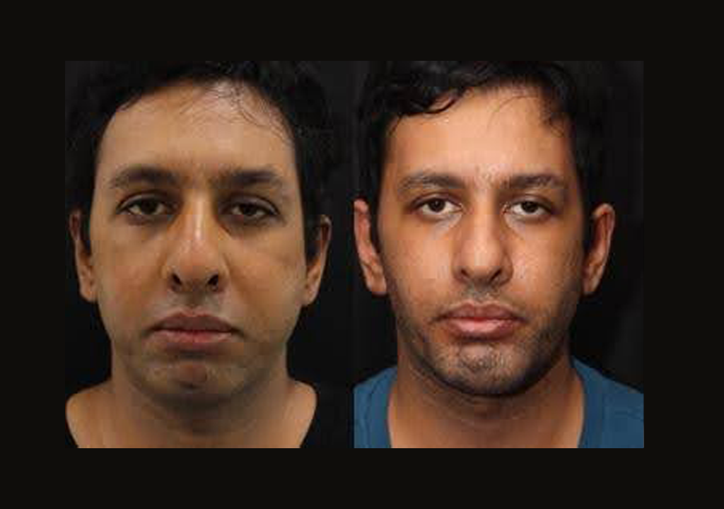 Buccal Fat Removal before and after Toronto 2