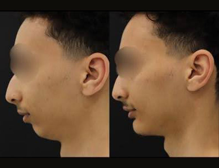 Chin reduction before and after