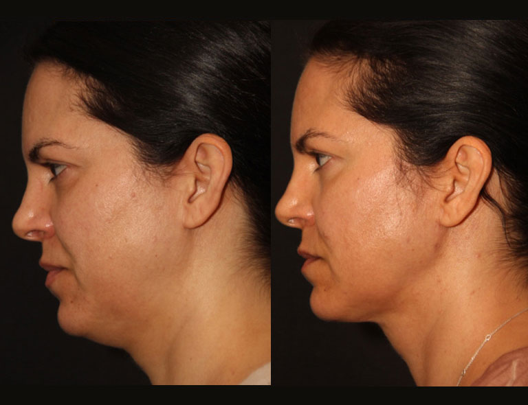 Neck Liposuction Before and After Patient 5