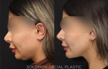Chin implant surgery in Toronto