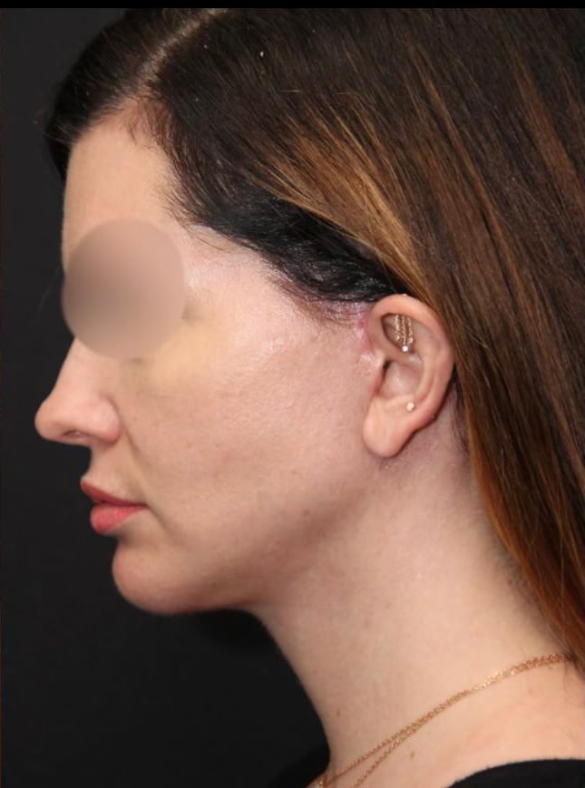 Before and After Vertical Deep Plane Facelift