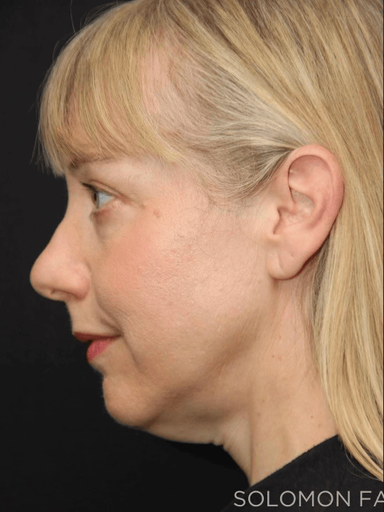 Before and After Deep Plane Facelift Photos