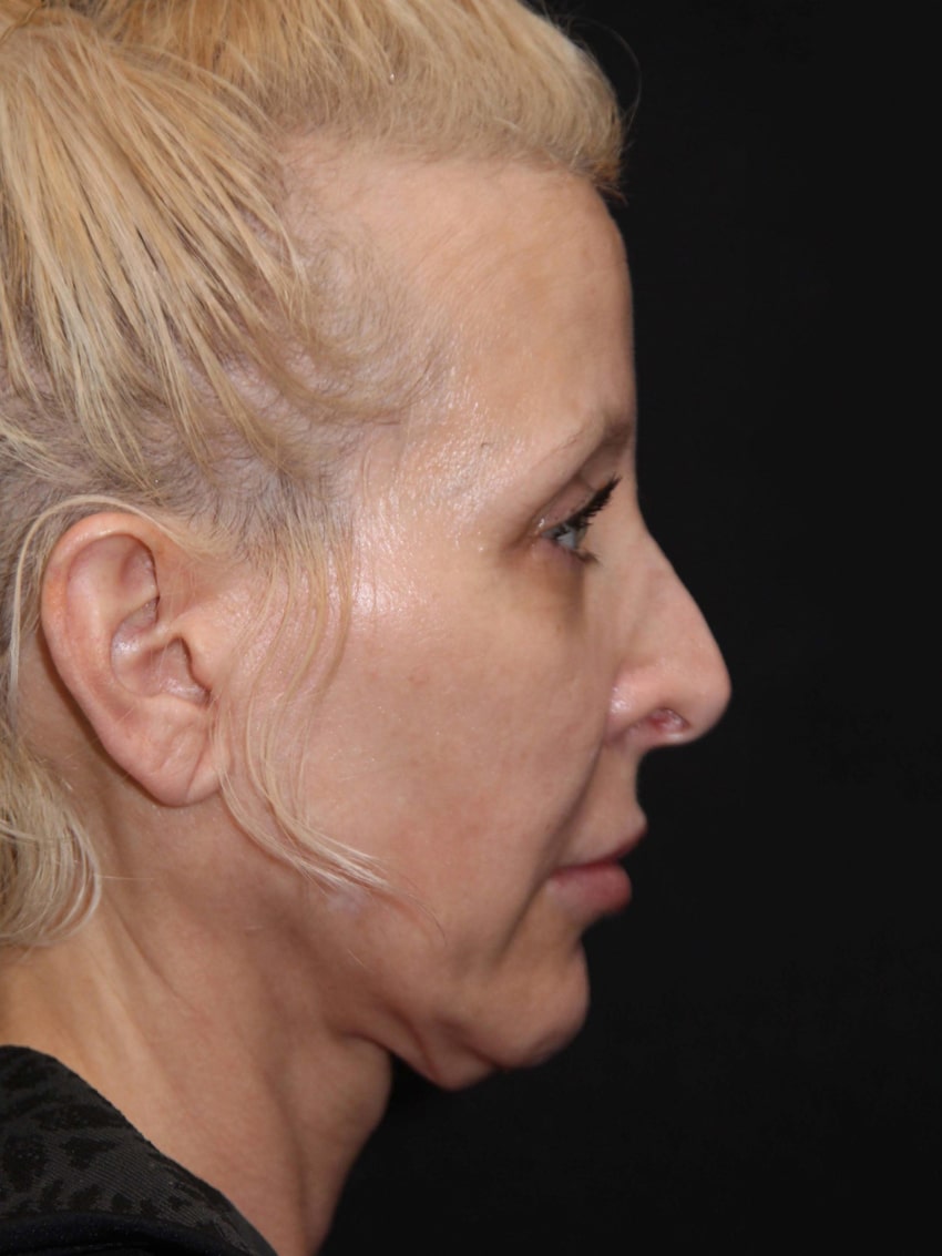 Facelift Before After Photos