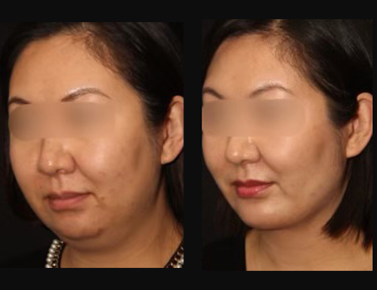 Neck Liposuction Before and After Patient 4