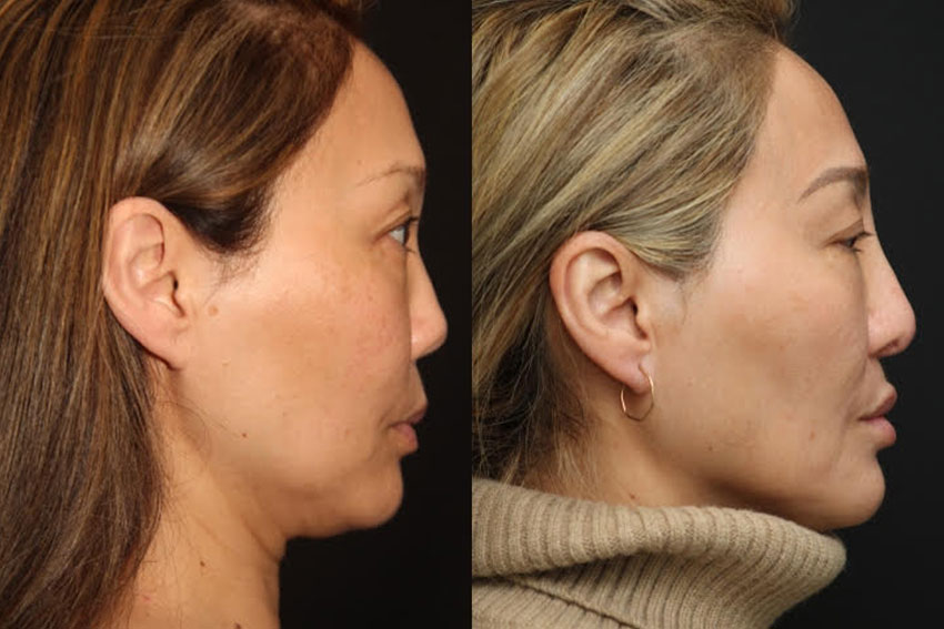 Before and After Asian Rhinoplasty