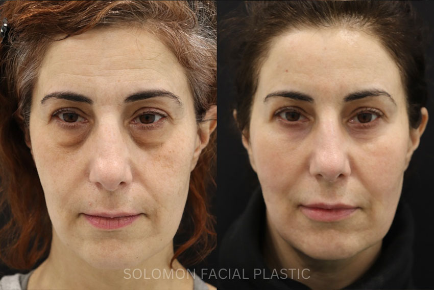 Before and After Fat Grafting