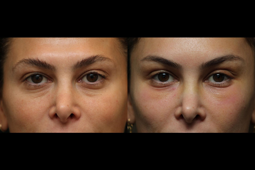 Before and After Fat Grafting