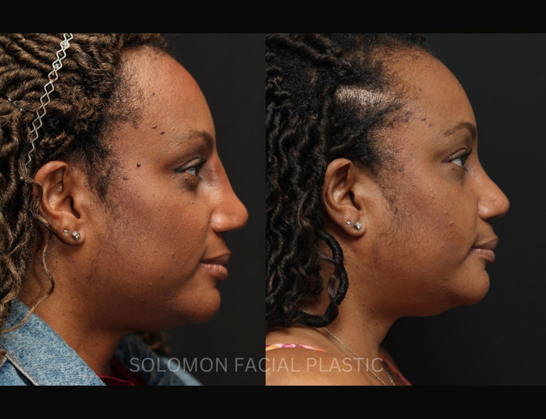 Before and After African American