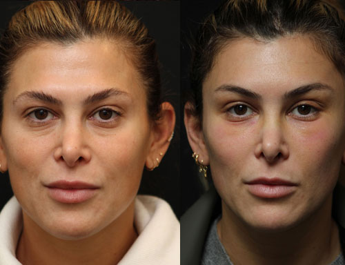 Brow Lift Before-After-2