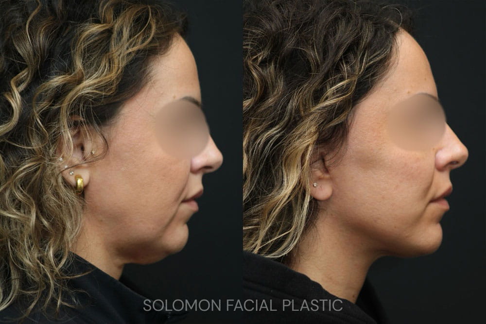 FACE LIFT BEFORE AND AFTER TORONTO 2