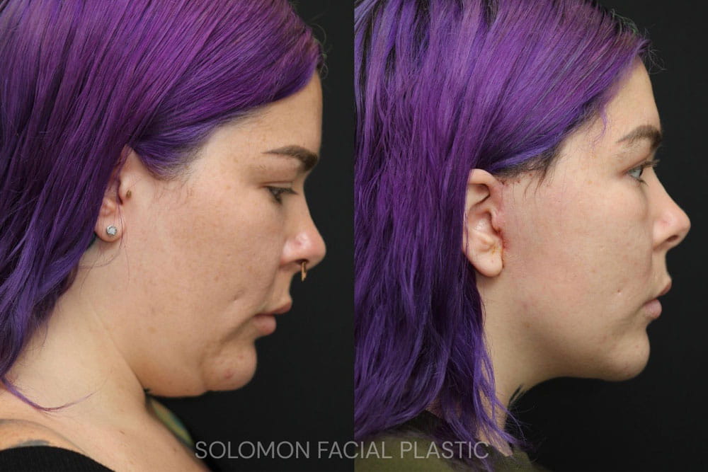 FACE LIFT BEFORE AND AFTER TORONTO 3