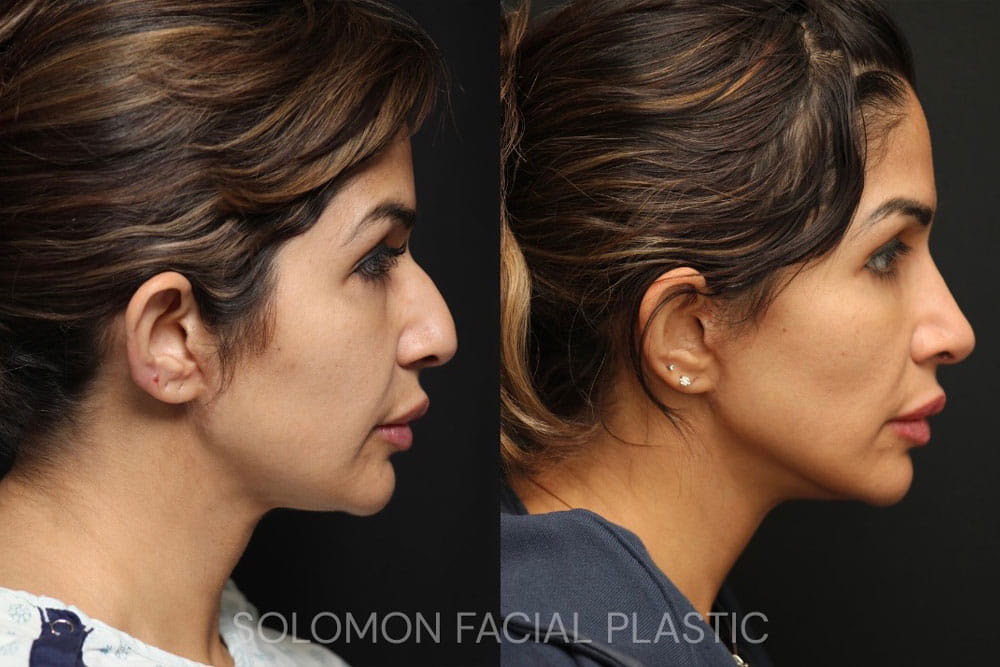 FACE LIFT BEFORE AND AFTER TORONTO