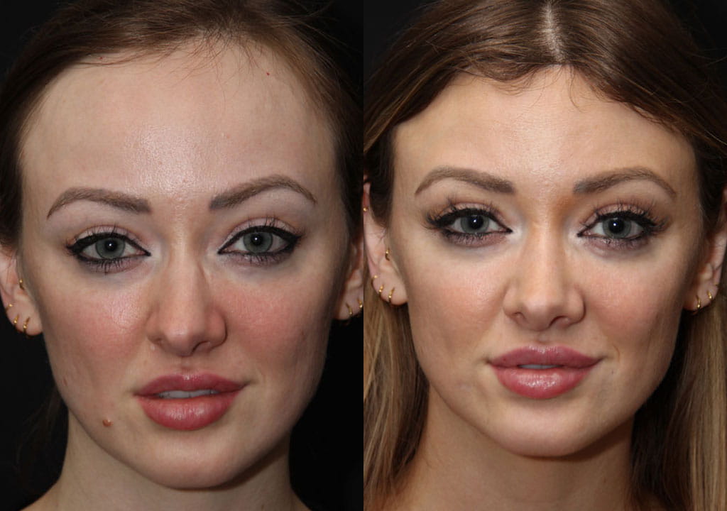 Hairline Lowering before and after Toronto 1