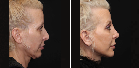 Deep Plane Facelift before and after Toronto 1
