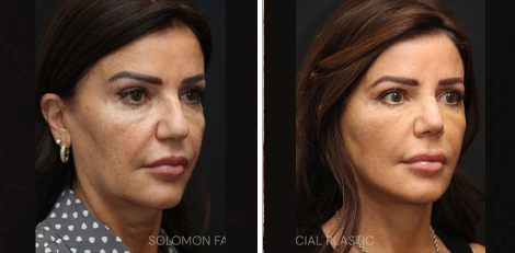 Deep Plane Facelift before and after Toronto 2