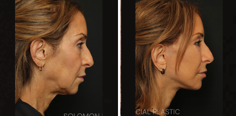 Deep Plane Facelift before and after Toronto 4