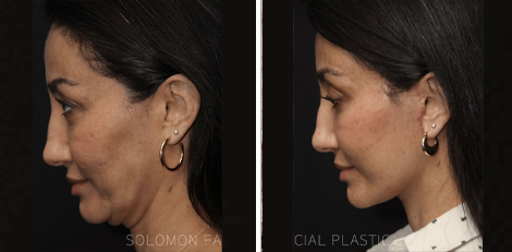 Deep Plane Facelift before and after Toronto 5
