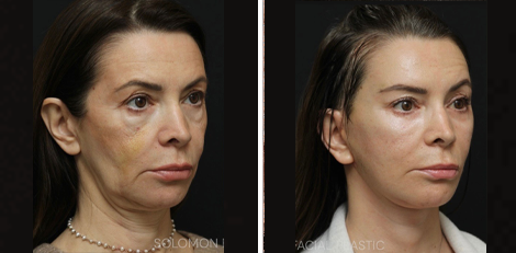 Deep Plane Facelift before and after Toronto 6