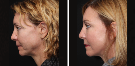 Deep Plane Facelift before and after Toronto 7
