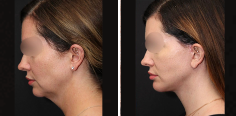 Deep Plane Facelift before and after Toronto 8
