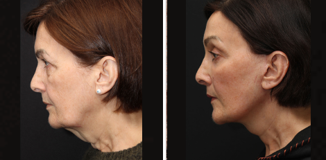 Deep Plane Facelift before and after Toronto 9